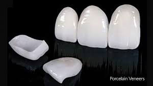 veneers1-image